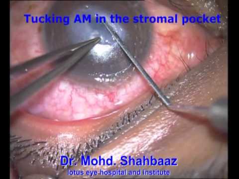 central corneal perforation repair with AM and glue and suture