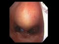Blue Rhino Percutaneous Tracheostomy (Bronchoscopic view) Blue Rhino Percutaneous Tracheostomy (Bronchoscopic view)