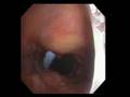 Blue Rhino Percutaneous Tracheostomy (Bronchoscopic view)