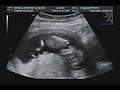 bebe 12 semanas bebe 12 semanas