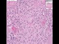 Histopathology Penis--Squamous cell carcinoma