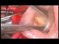 Neonatal Repair of TOF/PA