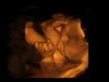 Corbins 3d ultrasound