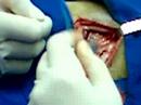 Lobectom�a veterinaria
