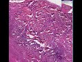 Histopathology Skin--Carbuncle