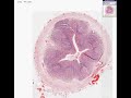 Histopathology Appendix--Pinworms