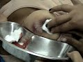 Mastitis Puerperal 2