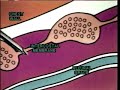 Intrapleural Anesthesia