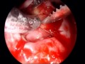 Rathke Cyst, Capsule Excision Rathke Cyst, Capsule Excision