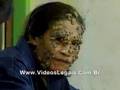 Homem árvore;o mais visto da internet postado por kisses boy
