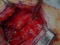 Movie 12 Subscapularis repair