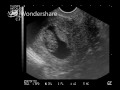Ultrasound 12.2.09.mp4