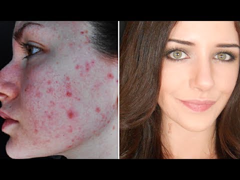 how to cover acne by makeup