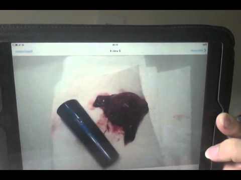 how to recover after miscarriage