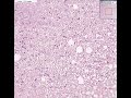 Histopathology Blood--Chronic lymphocytic leukemia Histopathology Blood--Chronic lymphocytic leukemia