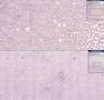 Histopathology Blood--Chronic lymphocytic leukemia