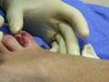 gross toe