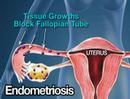 Infertility-Solution