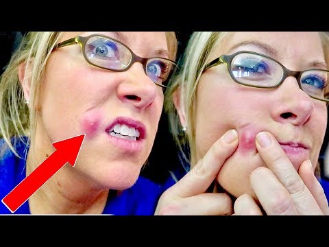 Staph Infection OR Spider-Bite?!