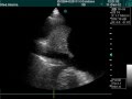 Pleural Effusion In Echography Exam Pleural Effusion In Echography Exam