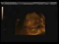 4D Ultrasound