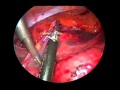 Laparoscopic Ladd's procedure for treatment of adult presentation of congenital intestinal malr