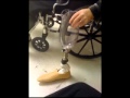 My amputation story