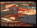 Cauda Equina tumor resection