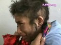 22-y old Fatima who has been abused and injured by her cruel husband in Herat - Western Afghanistan.Her toes were cut off by her husband and according to a doctor of a local hospital in Herat: 