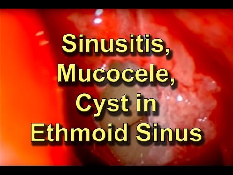 how to cure ethmoid sinusitis
