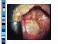 Posterior Microsurgical Approach for Cervical Herniated Disc