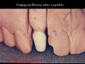 Click here to watch this video Coroas Procera