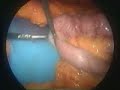 the mini gastric bypass (mgb) is a  short, simple, successful and inexpensive laparoscopic  gastric bypass weight loss surgery. the operation usually takes only 30 min., hospitalization less than 24 hours.  the mini gastric bypass is low risk, has excellent long term weight loss, minimal pain and can be easily reversed or revised. 3,471 people from all across america and around the world are choosing the mgb as the best in bariatric surgery.
- hard to believe? why not take a moment this minute and talk with over 4,901 people about the mgb!  or better yet call or email dr. rutledge right now: private cell phone: 702-953-7066 or 702-215-9550. email drr@clos.net