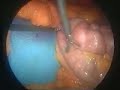 The Mini Gastric Bypass (MGB)