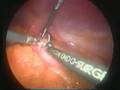 The Mini Gastric Bypass (MGB)