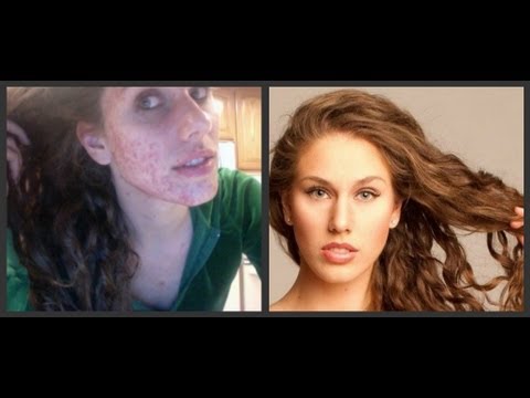 The Emotional Side Of Acne: LONG VIDEO!!!!