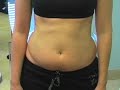 Liposuction
