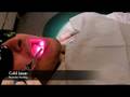 Laser Frenectomy
