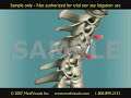 3D Medical Animation: Anterior Cervical Fusion