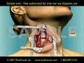 3D Medical Animation: Anterior Cervical Fusion