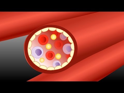 how to treat atheromatous aorta