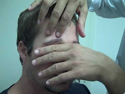 how to transplant eyebrows