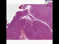 Histopathology Pituitary--Acidophilic adenoma