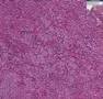 Histopathology Pituitary--Acidophilic adenoma