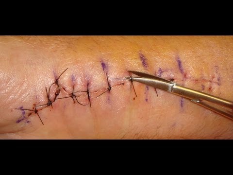 how to remove sutures