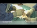 swissestetix Bauchplastik (tummy tuck)