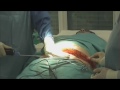 swissestetix Bauchplastik (tummy tuck)