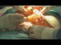 swissestetix Bauchplastik (tummy tuck)
