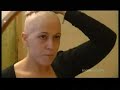 Female Alopecia Female Alopecia