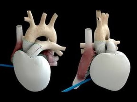 First Artificial Human Heart Transplant Performed in France